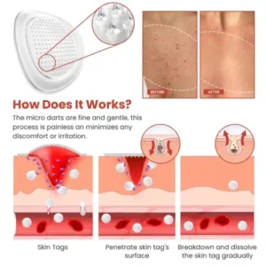 DermaSmooth Skin Tag Remover Patch – Fast, Safe, And Painless Skin Tag And Mole Removal Solution With No Scarring Or Pig
