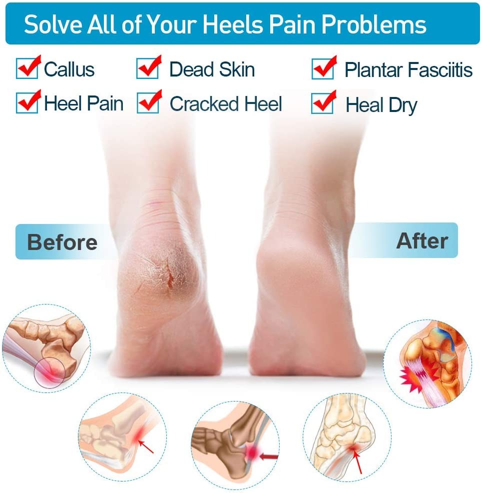 41e66a8fab6b34297b9235c8e9870c52 Silicone Heel Protector Sleeve for Cracked Heels & Pain Relief – Breathable & Cushioned Support - Image 4
