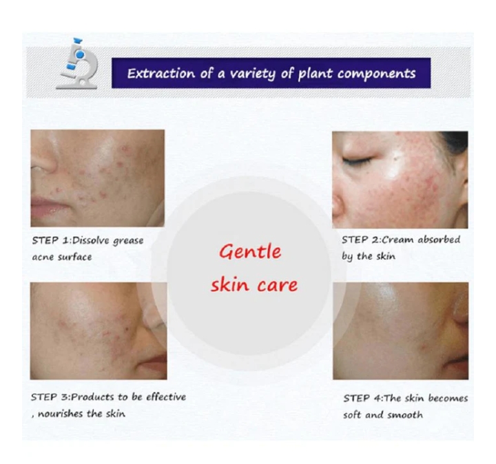 WhatsApp-Image-2024-11-28-at-8.35.39-AM-1 BIOAQUA Anti Acne Cleanser For Removal Of Acne - 100ml