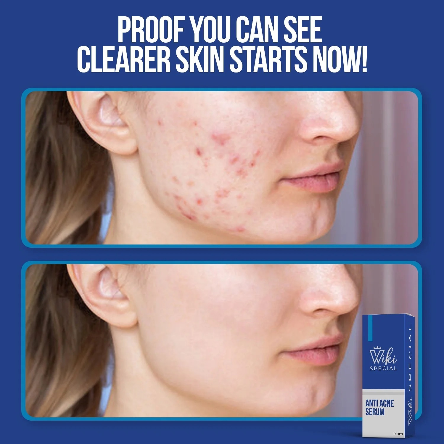 dff8f18af61ef32a077ca954b24cc03e Wiki Special Anti Acne Serum | Clears Acne, Soothes Skin & Fights Blemishes (30ml) - Image 3