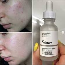 download-3-2 The Ordinary Niacinamide 10% + Zinc 1 % - 30ml - Image 4