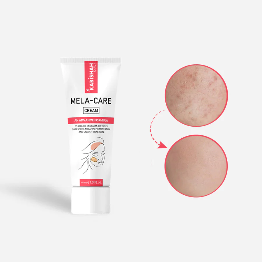 f2c9257690c441b7904d4bbae896ae96 Kabishah Mela-Care Cream Advanced Formula For Melasma, Freckles, Dark Spots, And Uneven Skin Tone 50ml - Image 3