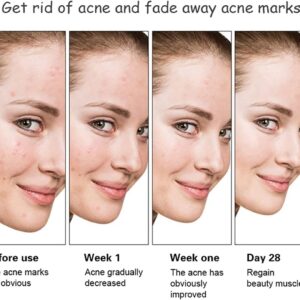 Aichun Beauty Anti - Acne Whitening Facial Serum Aloe Vera Extract Salicylic Acid Repairs Damaged Skin | 30ml