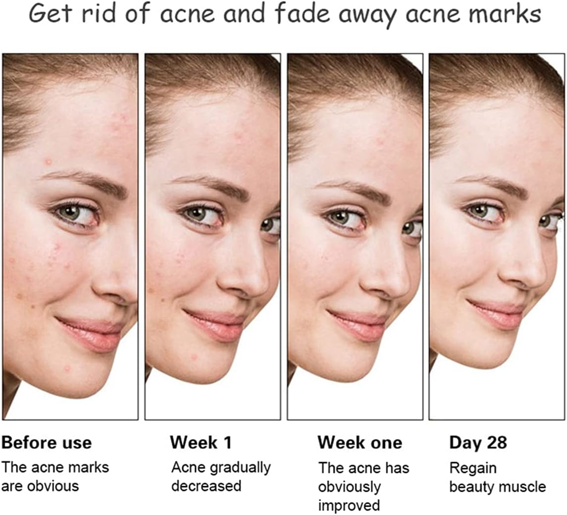 Aichun Beauty Anti - Acne Whitening Facial Serum Aloe Vera Extract Salicylic Acid Repairs Damaged Skin | 30ml