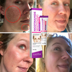 Nicotinamide Whitening Freckles Cream Remove Melasma Dark Spot Acne Marks Lightening Melanin Brightens Skin Tone Face Sk